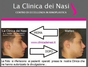rinoplastica matteo 30