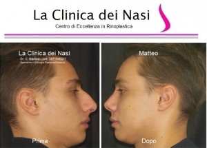 rinoplastica matteo 40