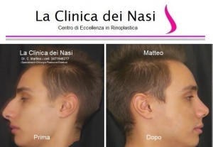 rinoplastica matteo 50