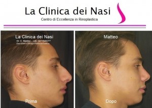 rinoplastica matteo 60