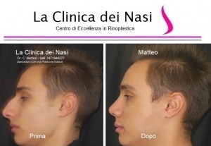 rinoplastica matteo 70