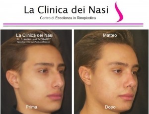 rinoplastica matteo 80