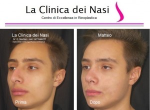 rinoplastica matteo 90