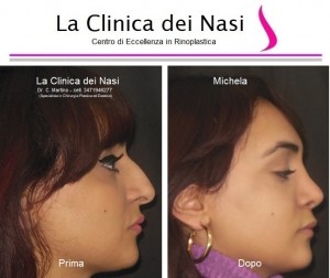 rinoplastica michela 11