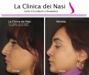 rinoplastica michela 12