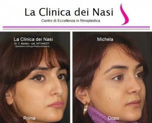 rinoplastica michela 15