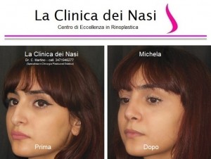 rinoplastica michela 18
