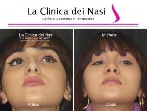 rinoplastica michela 19