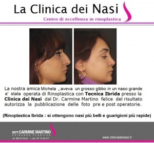 rinoplastica michela 2
