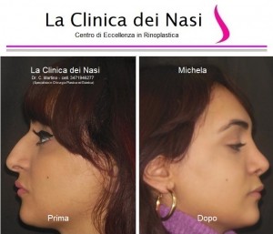 rinoplastica michela 5