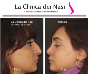 rinoplastica michela 7